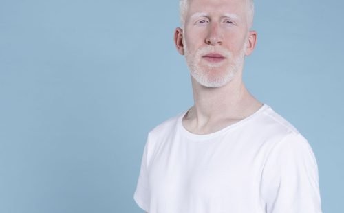 homem_albino.jpg