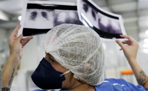 radiografia_de_torax_coronaviruscovid-19_hospital_sao_paulo1205200325.jpg