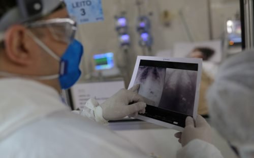 radiografia_de_torax_coronaviruscovid-19_hospital_sao_paulo1205200326.jpg